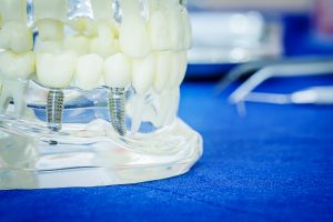 dental implant sample