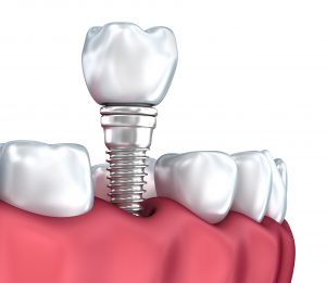 3D illustration of dental implant