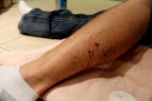cut on man's leg