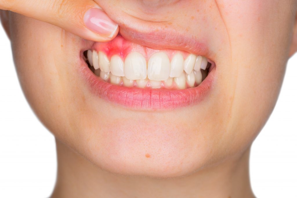 woman showing her gum is inflamed
