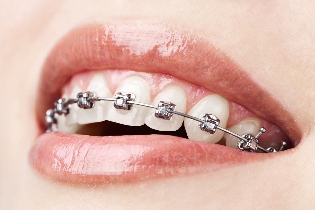teeth having braces