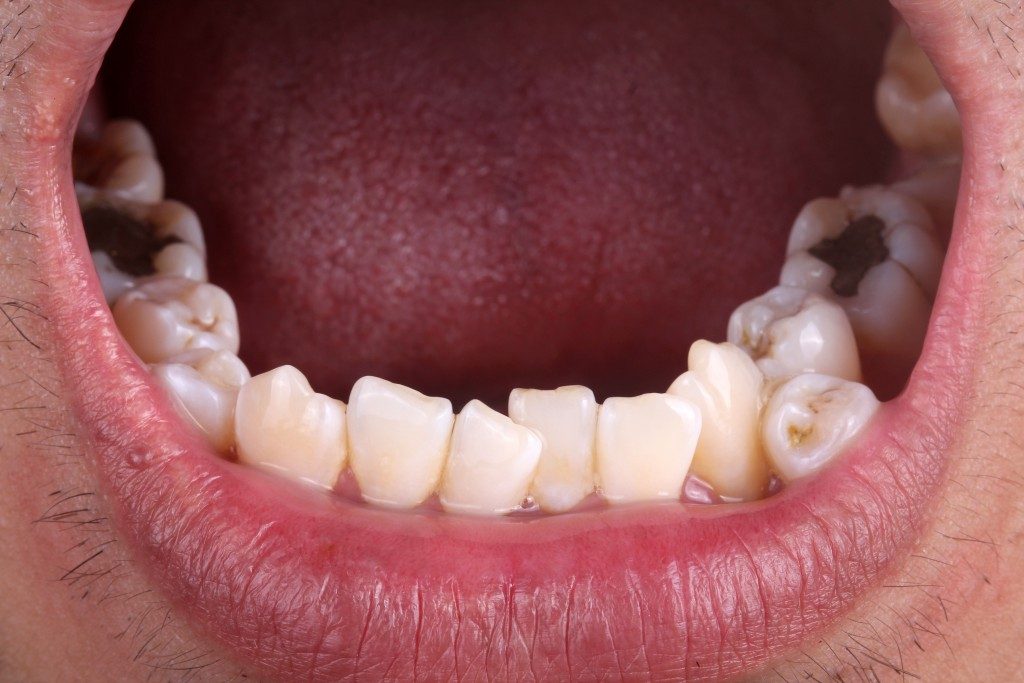 crooked and bad set of teeth