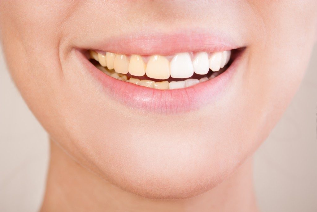 woman with half discoloured teeth