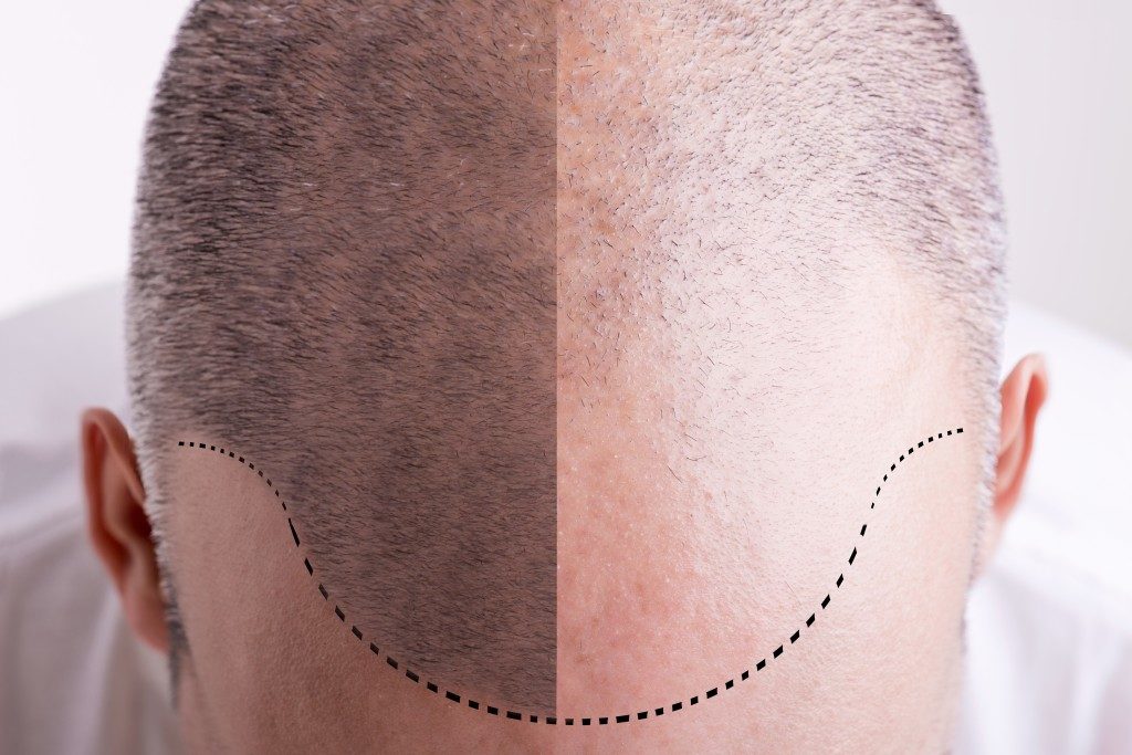 Top view man's head before and after