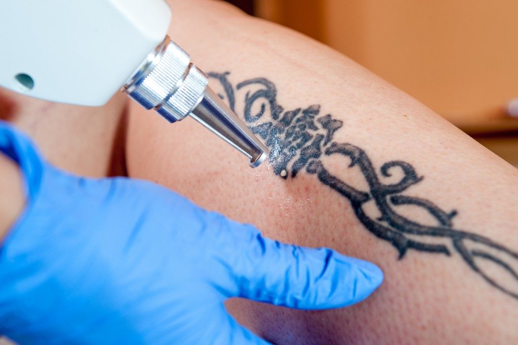 Leg tattoo being removed using a laser