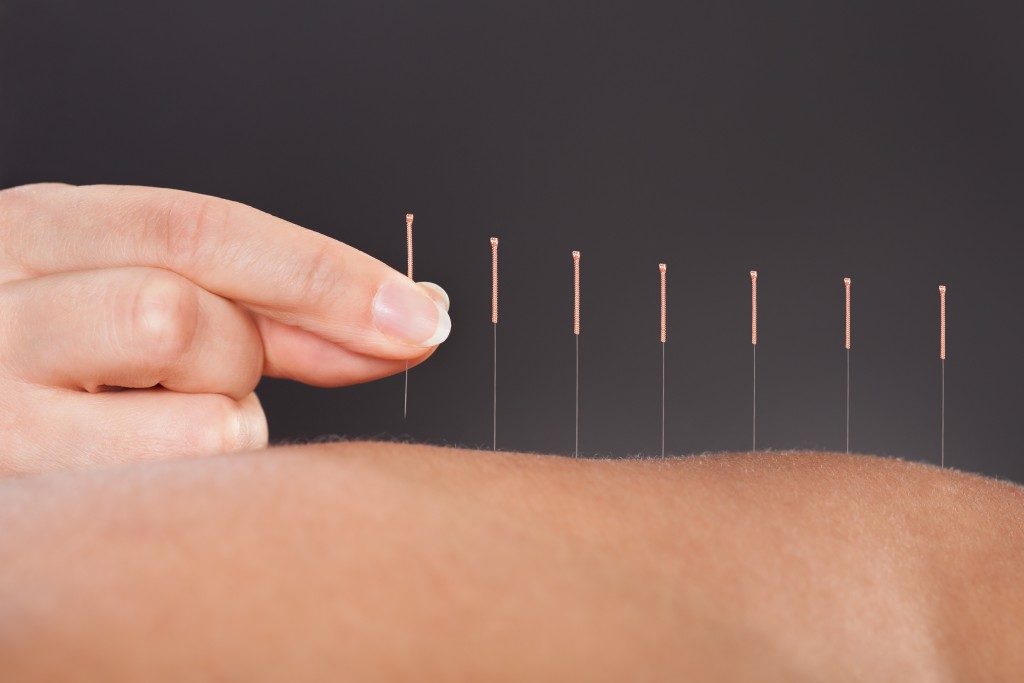 Acupuncture needles on skin