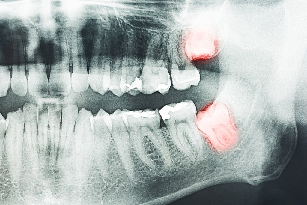 wisdom teeth