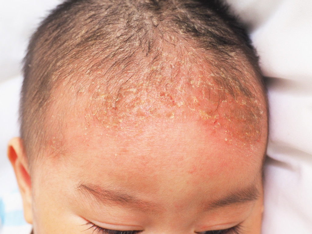 toddler with skin allergy