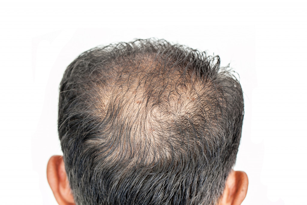 thinning hair on the back side of the head