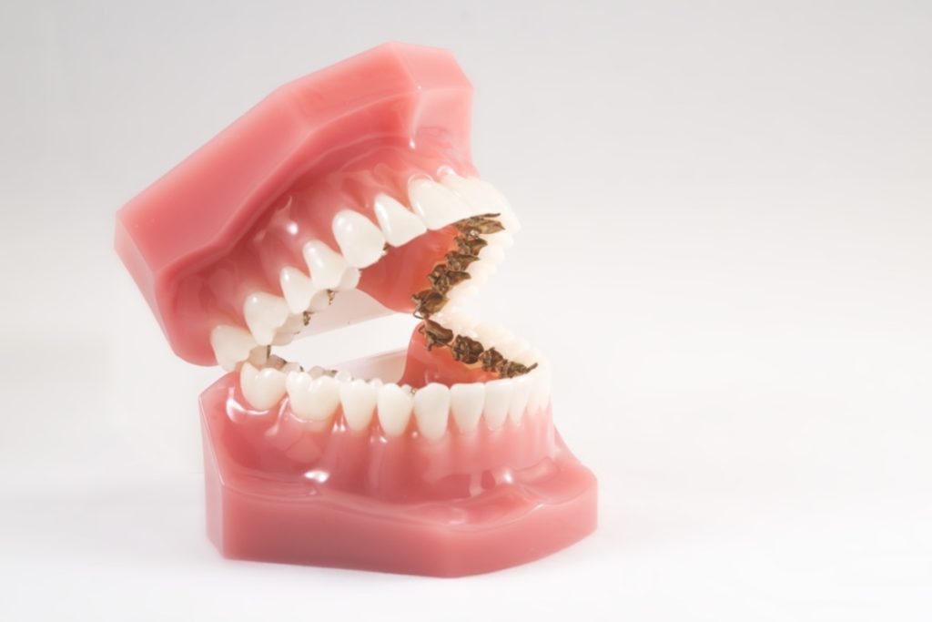 lingual braces