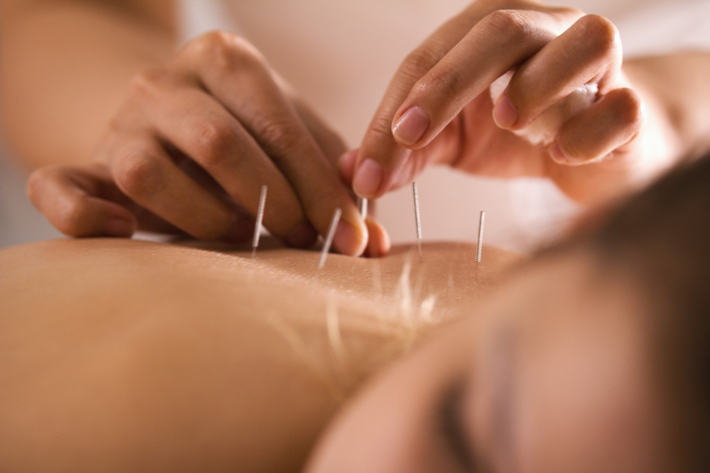 a woman lying on her back getting an acupuncture session