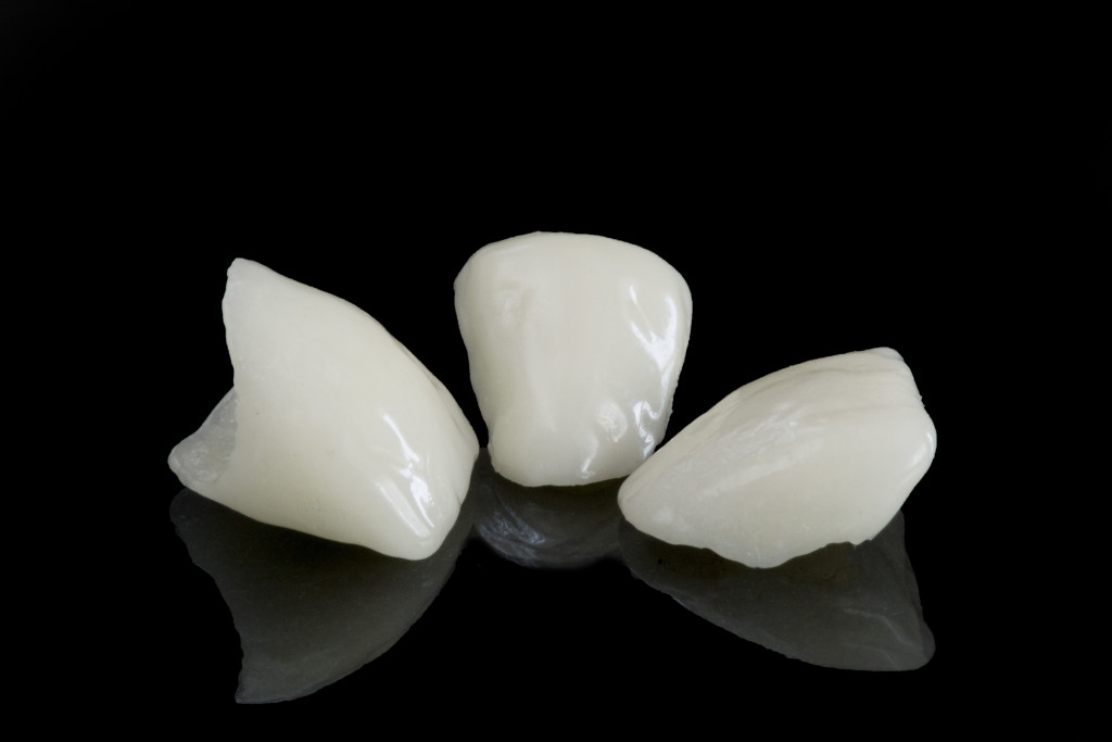 Various teeth removed due to tooth loss